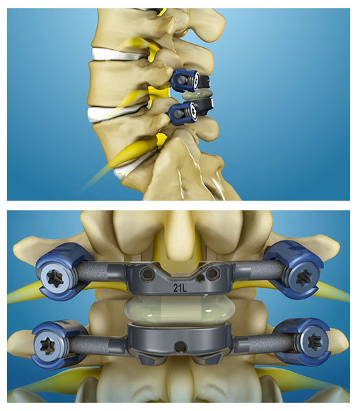 Spinal Stenosis Treatment - TOPS System