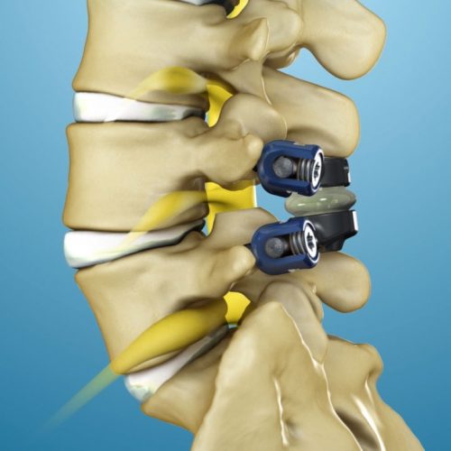 Spinal Stenosis Treatment | TOPS™ System by Premia Spine