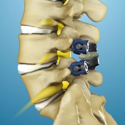 Mechanical Spinal Implant Company
